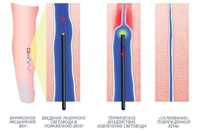 Удаление вен лазером - эндовазальная лазерная коагуляция - ЭВЛК