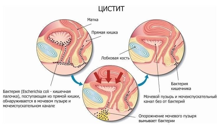 Цистит и уретрит: Практические подходы к диагностике и лечению