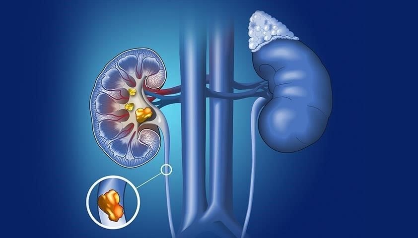 Влияние почечных камней на мочеиспускание и функцию почек