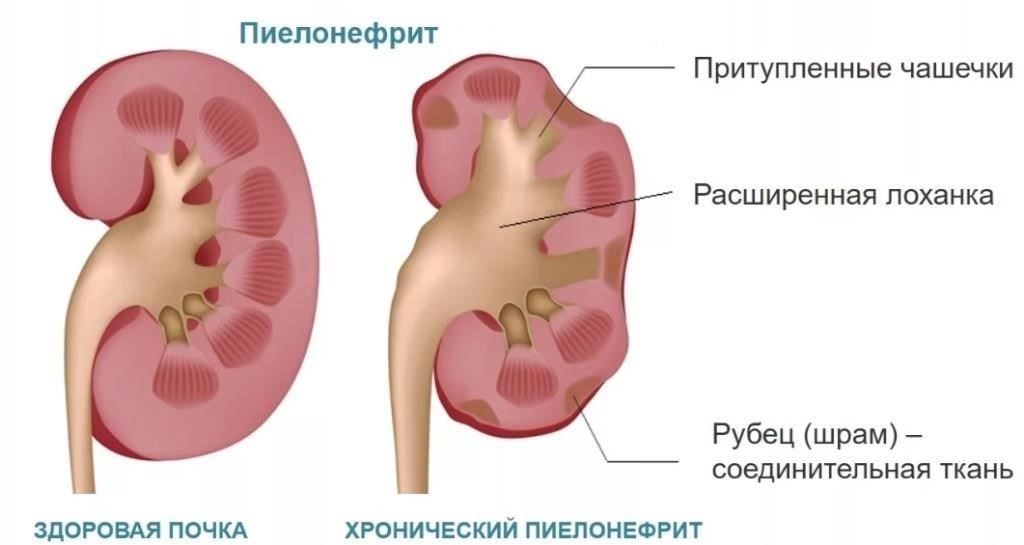 Вторичный пиелонефрит: Понимание связи с патологиями мочевыделительной системы